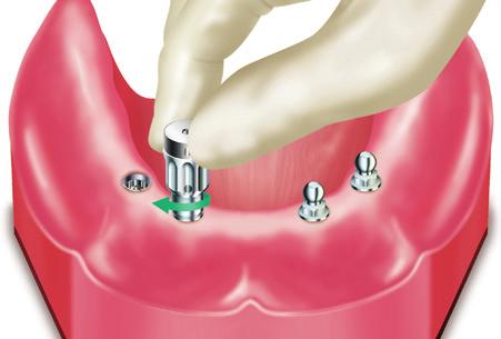 Snap Abutment System Thread the Snap Abutment into the implant using the Overdenture Abutment Driver or the Overdenture Torque Tip and the Conversion Handle. Torque the Snap Abutment to 30 Ncm.