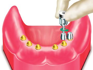 NOTE: An implant-retained, tissue-supported prosthesis is indicated when there are fewer than four implants in the mandible and fewer than six in the maxilla. a. Intended Applications Multiple-unit restorations.