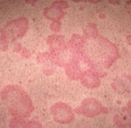 The Definition A subgroup of chronic urticaria (CU) Lesions reproducibly triggered by