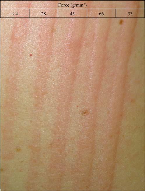 Simple Dermatographism Provocation testing: (Urticaria Factitia) Rubbing the skin of the upper back or the volar of the