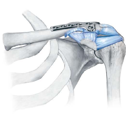 Lateral Clavicle Fractures continued 3 Fixation One or two screws (either 3.5 mm cortex or 4.0 mm cancellous bone screws) can be placed in the lateral plate holes.