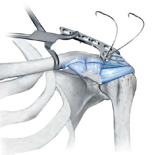 Dissect the soft tissue, posterior to the acromioclavicular joint, to prepare a path for the insertion of the hook. Perform any ligament or capsule repairs.