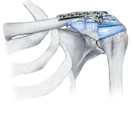 Dislocation of the Acromioclavicular Joint continued 3 Fixation If sutures are used to repair the ligaments, the sutures can be passed through the lateral hole(s) of the plate and tied under tension