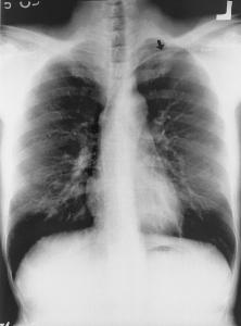 Chia-Lo Chang, et al 426 Fig. 1 Satisfactory placement of the port-a-cath system and the usual site for the pinch-off sign (arrow). Fig. 2 Chest radiograph showing fractured catheter in the right side of the heart.