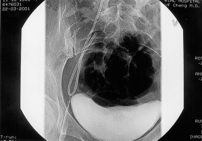 Early complications include incorrect position, improper anchoring of the reservoir, skin infection, sepsis, vascular perforation with hemothorax or hemorrhagic pericardial effusion, and pneumothorax.