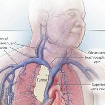 SVCO Compression of superior vena cava due to tumour or nodes in mediastinum Common with lung cancer, possible with lymphoma SVCO Symptoms Swelling of face, neck, arms Headache Dizziness