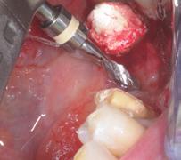5 Occlusal view of the gap 8 Subcrestal insertion of implant In order to minimize possible