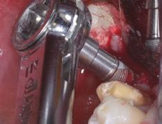 9 Subcrestal insertion of implant 6 Preparation of implant tunnel The implant was inserted using a