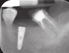 The successful osseointegration of the implant is visible on the 4 month follow-up X ray and all tissues appear to be well healed (Fig. 17,18) 17 Rx after 4 months References 1. Christoph H. F.