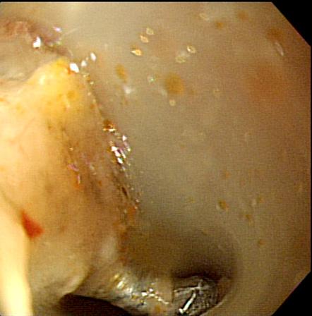 Kim J et al. Fluoroscopy-Guided Endoscopic Removal A C D Fig. 3. Endoscopic removal of the nail under fluoroscopic guidance. (A, ) The nail in the fundic area.