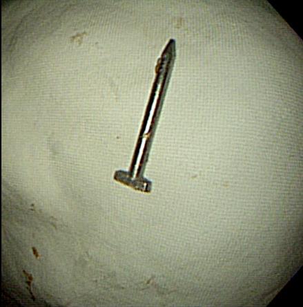 In both patients, the ingested foreign bodies a nail and a button battery were successfully removed by endoscopy using alligator forceps and a protector hood or a basket with fluoroscopic guidance.