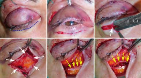 In extraperiorbital approaches, a careful dissection of the periorbita from the orbital bones is conducted and carried as far as the superior and inferior orbital fissures.