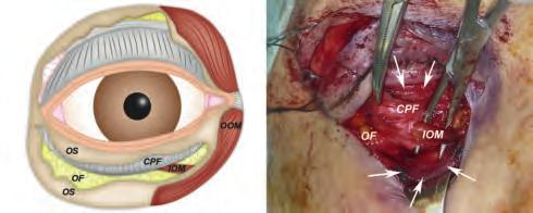 20 Endoscopic Orbital and Transorbital Approaches A B Fig. 4.7 Deep dissection in an inferior eyelid approach.