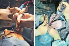 In transpalpebral procedures, it has proven helpful to assign a third surgeon with the task of creating an adequate working space by
