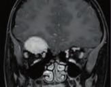 CT imaging showed a suspected bony lesion.