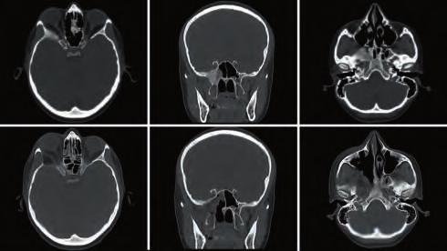 Selection of Clinical Case Histories 51 Case 22 Complex Right Sphenoidal Meningioma Invading the Floor of the Middle Cranial Fossa, Greater Wing of the Sphenoid, Pterygoid Plates and Sphenoid Sinus A