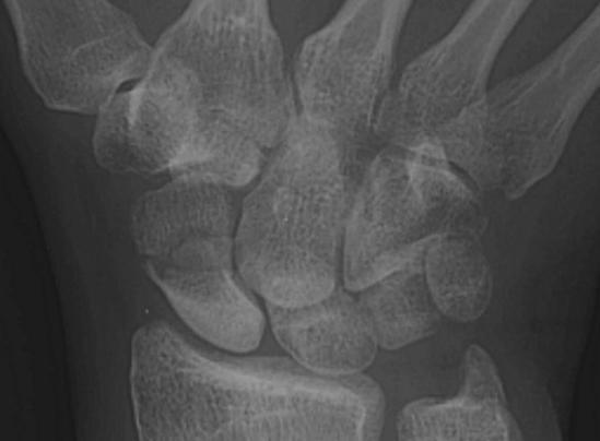 Scaphoid fracture Most common carpal fracture 10-20% occult Distal blood supply Proximal fx worse Delayed complications: Non-union Avascular necrosis AVN, non-union Frequent occult fractures +