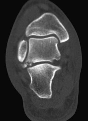 Avoiding Pitfalls (ankle/foot): Fracture of the Lateral process of the Talus Snowboarding