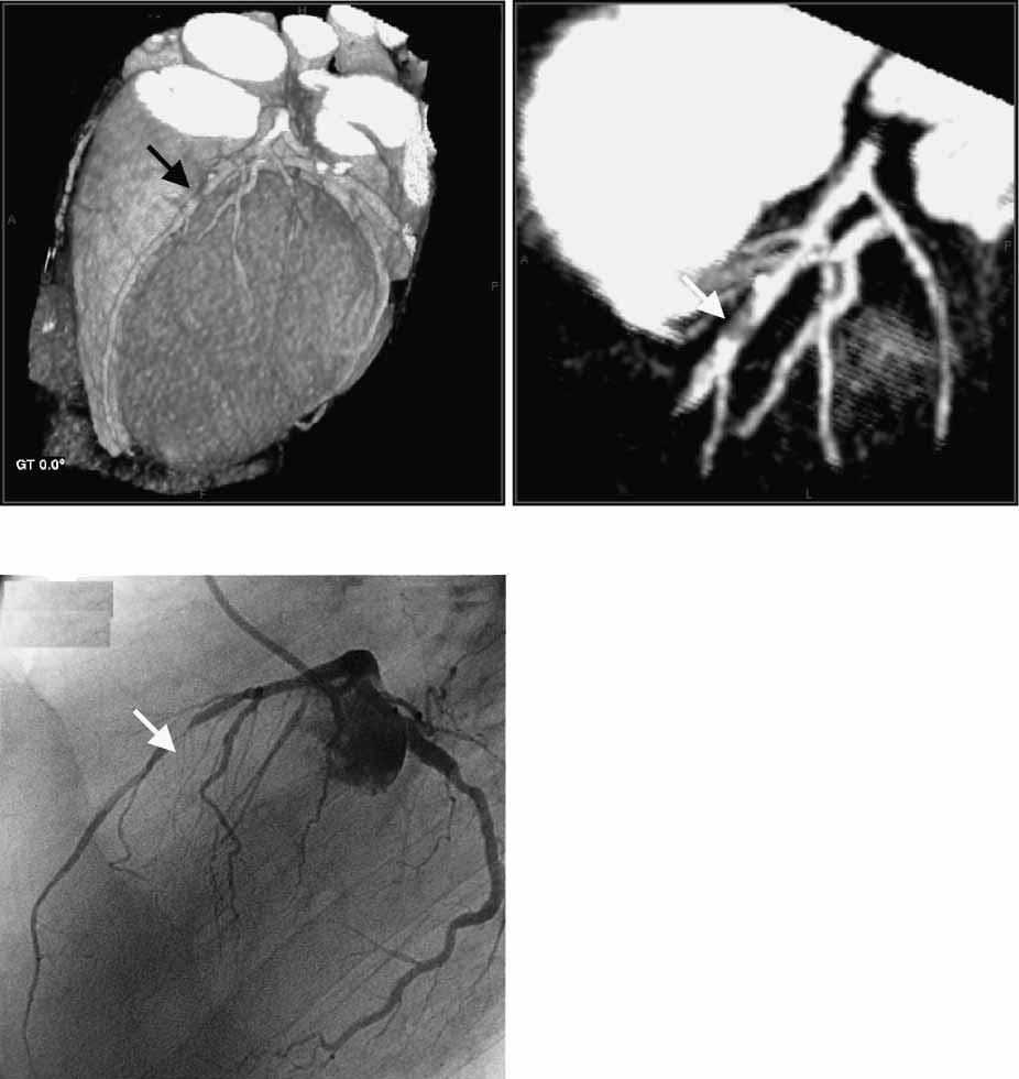 Non-invasive coronary angiography 1723 Figure 8 (a c) MDCT coronary angiography and conventional coronary angiography: Volume rendered image (a) depicts high grade stenosis (arrow) in the LAD.