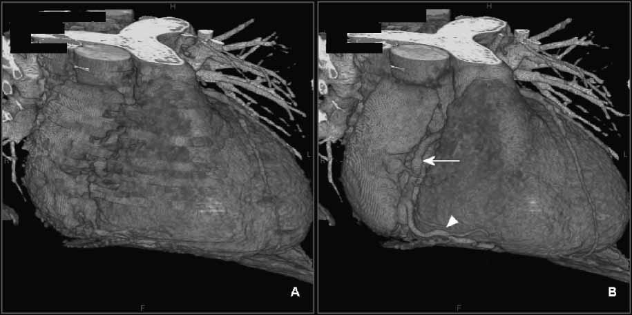 1718 A. F. Kopp et al. Figure 3 (a, b) Sixty-year-old patient, mean heart rate 65 beats. min 1 ; image reconstruction for RCA (arrow) at (A) 60% and (B) 40%.