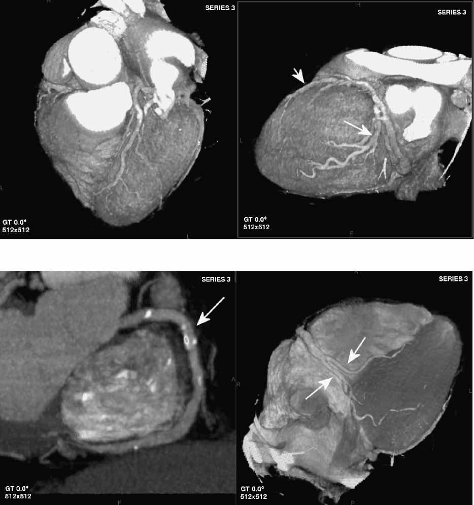 Non-invasive coronary angiography 1719 Figure 4 Three-dimensional reconstruction of coronary MDCTA with volume rendering technique (a, b, d) and maximal intensity projection (MIP) (c).