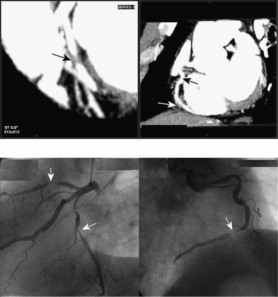 Non-invasive coronary angiography 1721 Figure 5 (e h). Figure 5 Male patient, age 55, with situs inversus and two-vessel disease, s/p balloon angioplasty of proximal RCA and prox.