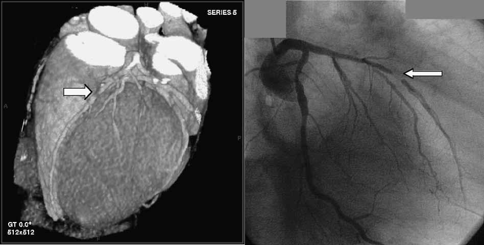 Patient came in for follow-up performed with both coronary CT angiography (a) and conventional angiography (b).