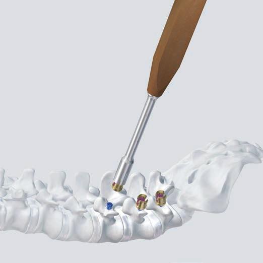 General Surgical Technique c. Attach 3-D head 388.368 Positioning Holder for Click X 3-D Head with Disconnecting Device Using the Positioning Holder, pick up a Click X 3-D Head from the implant rack.
