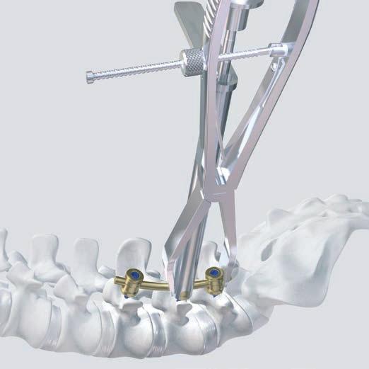 a. Lordotic manipulation: Compress or distract with mobile 3-D heads to reposition curvature 388.422 Compression Forceps, length 335 mm, for Pedicle Screws 388.