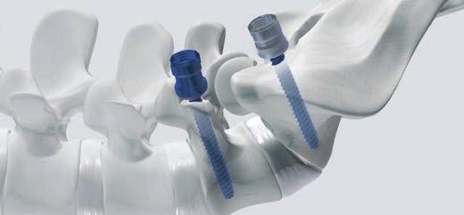 For pedicle screw placement refer to the surgical technique described earlier in this brochure. For a single level spondylolisthesis reduction two methods are possible: a.