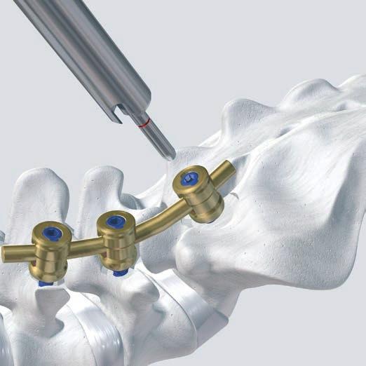 Removal of Click X Implants with Damaged Hexagonal Socket Required instrument sets 01.606.