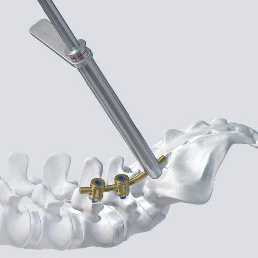 Removal of Click X Implants with Damaged Hexagonal Socket Turn the handle counter-clockwise to secure the Extraction Screw in the damaged socket of the