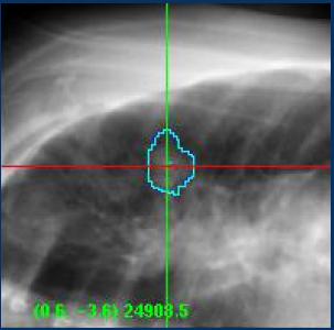 Xsight Lung: How does it work?