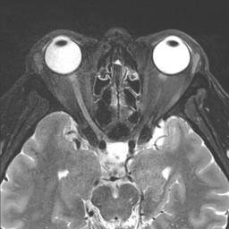 Optic neuropathy Cranial