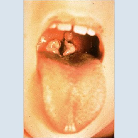 Diphtheria:This is a picture of the throat of a child who has diphtheria.