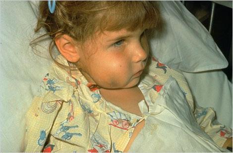 Haemophilus influenzaetype b:this girl is hospitalized with Haemophilus influenzaetype b (Hib) infection shown here