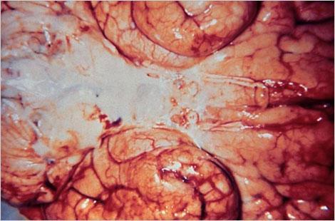Inferior view of a brain infected with
