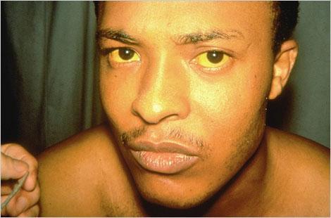 Hepatitis A:Hepatitis A infection has caused this man s skin and the whites of his eyes to turn yellow.