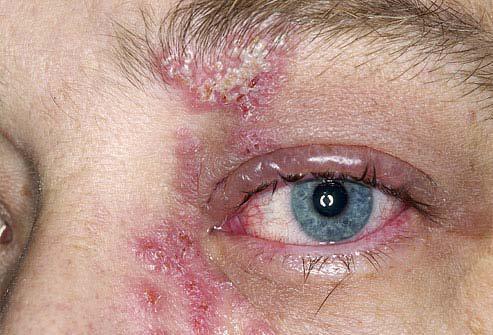 Herpes Zoster (shingles):a dangerous complication of shingles infecting the eye which can lead to loss of vision.