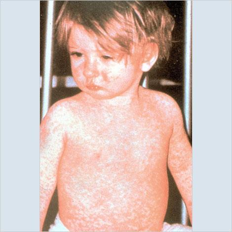 Measles rash covering