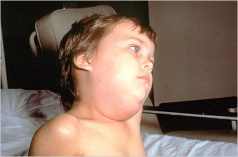Child's face displaying diffuse lymphedema of the neck