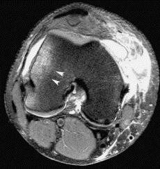 Location of MPFL tear MPFL disruption at the femoral attachment was related to more frequent