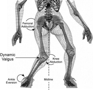 Mechanism of injury Knee valgus stress and internal rotation of the femur with the foot fixed on the ground Risk factors: Tall height and excess