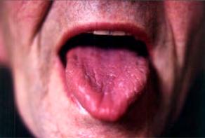Tongue Coatings and Clinical Indications Tongue Coat Indications thin normal exterior condition, wind-cold thick excess damp/phlegm food stagnation dry heat consuming yin excess yang or fire