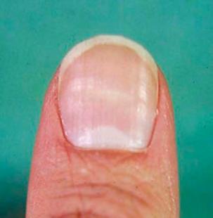 V Vascular disease includes the anoxic (lack of Oxygen transfer) disorders that cause clubbing, iron deficiency anemia that causes spoon nails or koilonychia, Raynaud disease, vasculitis