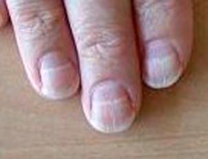 I Inflammatory diseases that involve the nail bring to mind fungus infections causing onychia (nail bed inflammation), paronychia, syphilis (which can cause almost any nail change), SBE (sub acute