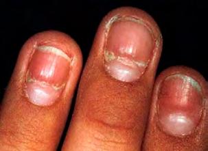 N Neoplasms do not usually cause nail changes, with the exception of clubbing and pallor from secondary anemia.