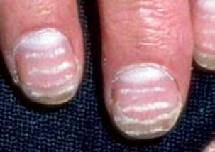 Nails may exhibit many different abnormalities. In the condition known as koilonychia ( spoon nails ), the nails are flattened and have concavities.
