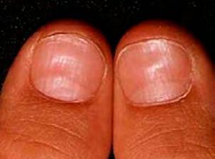 If the infection goes on and on then a fungal infection is often the cause and this needs anti-fungal cream or paint to treat it. Leukonychia striata = white striations on the nails.