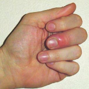 (These are the sort of white marks people associate with zinc deficiency) A group of oncologists describe how a patient on chemotherapy developed fingernail anomalies.